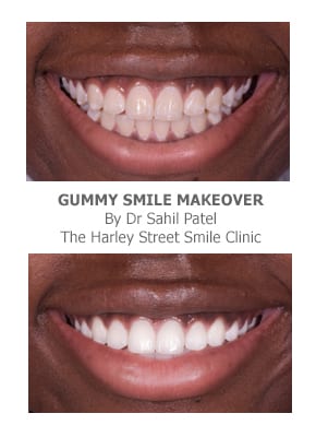 Gummy Smile Makeovers