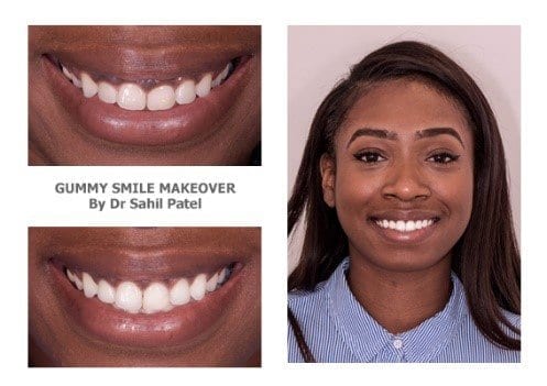 Gummy smile makeovers