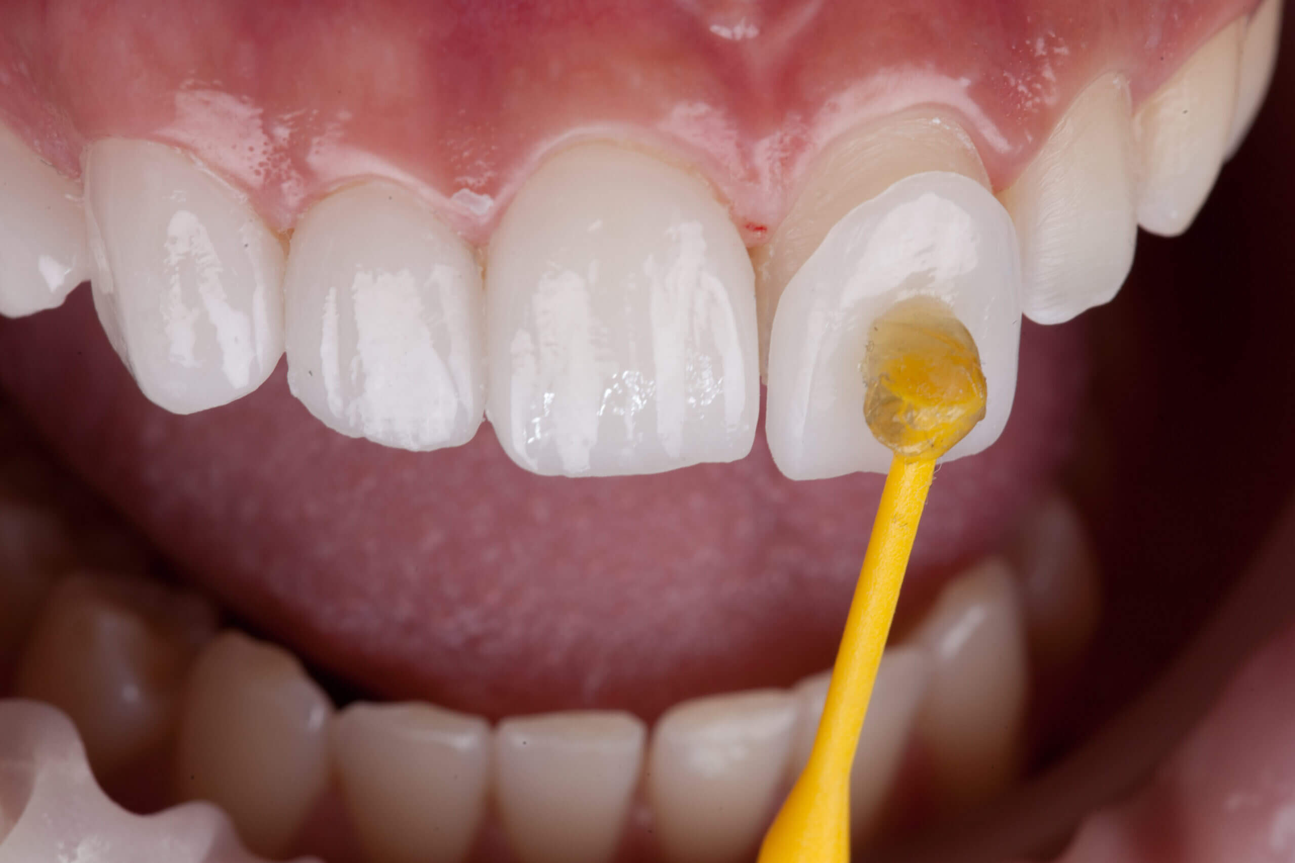 Close-up of composite resin being applied to front teeth during restorative dental procedure