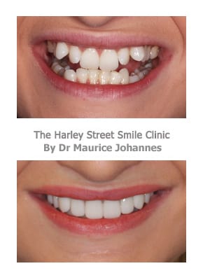 Protruding Canine Teeth Harley Street Smile Clinic