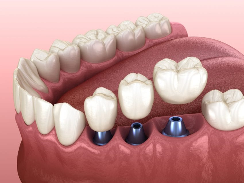 Veneers vs Crowns - Harley Street Smile Clinic