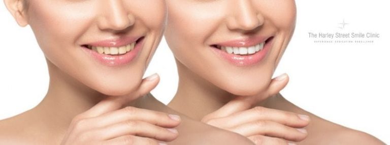Veneers vs Implants - The best treatment for you