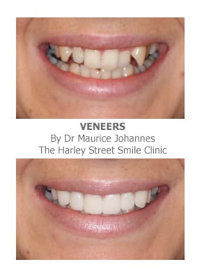 Veneers for Crooked Teeth | Harley Street Smile Clinic