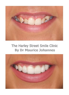 Gummy Smile and Crooked Teeth Smile Gallery