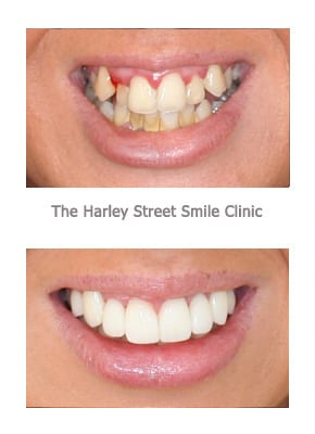Gummy Smile and Crooked Teeth Smile Gallery