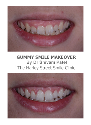 Gum Contouring London - Harley Street Smile Clinic