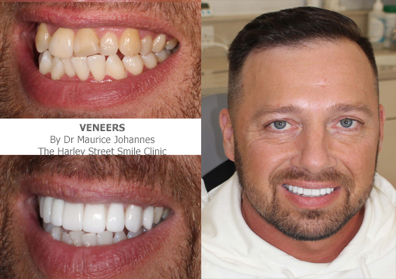 Veneers latest smile